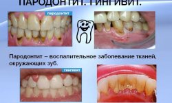 Отбеливающие полоски для зубов crest