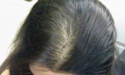 Средства от выпадения волос отзывы трихологов